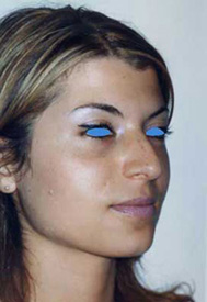Chirurgia Estetica - Rinoplastica - foto prima dopo.